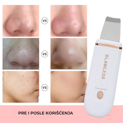 Ultrazvučna Špatula